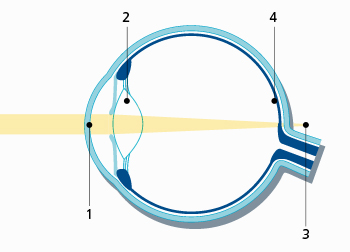 노안이 생기면 빛이 각막(1)을 지나 수정체를 통과(2)하지만, 수정체의 굴절력이 떨어져 빛의 초점(3)이 망막의 뒤쪽에 맞춰집니다.(4)