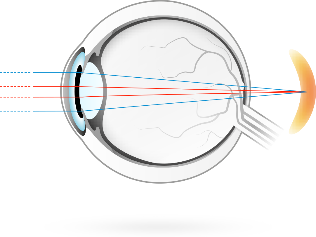원시 – 시각 이미지 초점이 망막 뒤에 맺혀, 눈이 근거리 물체에 초점을 맞추기 힘들어지는 증상