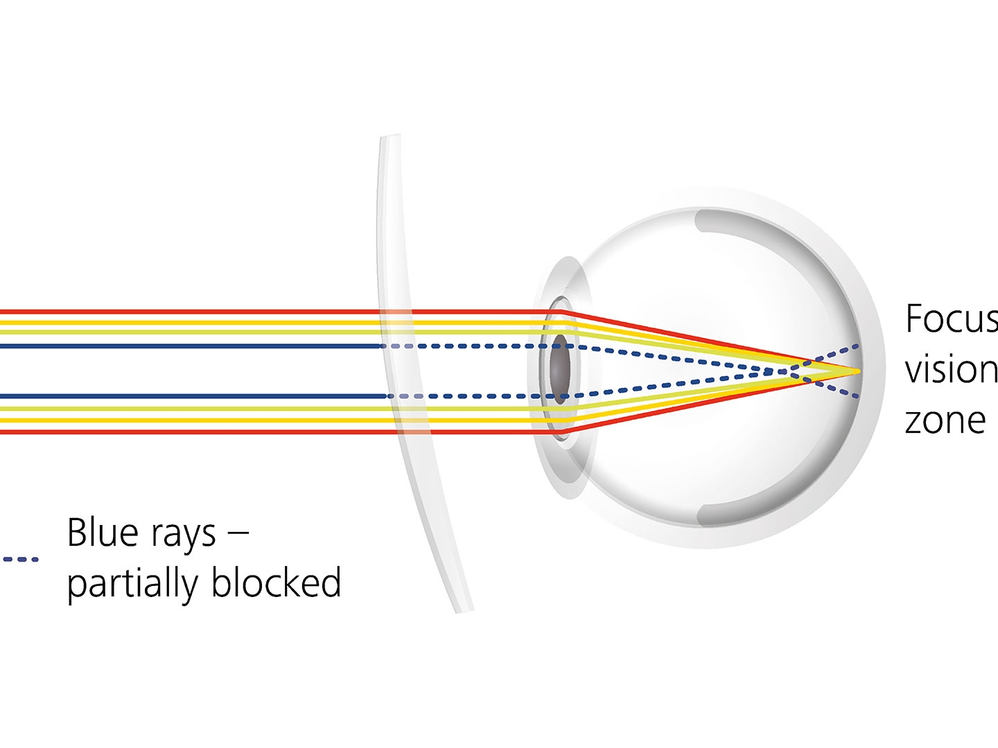 렌즈 코팅이 블루라이트 일부를 차단하여 눈부심을 줄이는 방식을 보여주는 이미지 