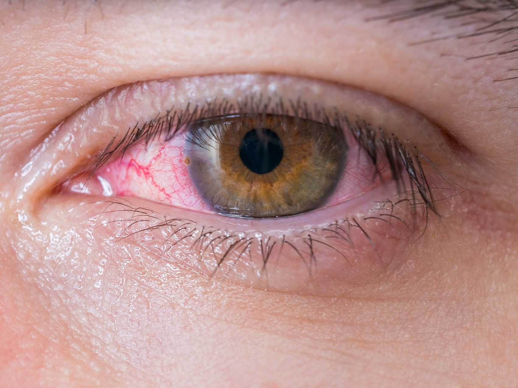 잠재적인 눈 건강 문제를 보여주는 건강하지 못한 눈의 클로즈업 이미지. 